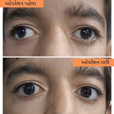  Squint Treatment in Delhi | Bharti Eye Foundation