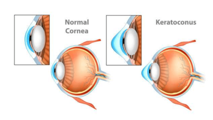 Intravitreal Injections in Mumbai | Expert Care at Shreeji Eye Clinic