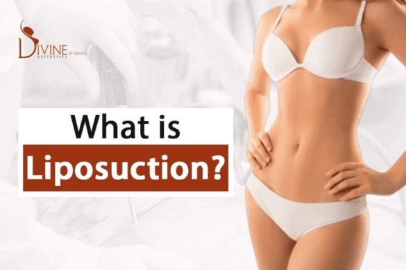  What is Liposuction? Is There Any Risk in Liposuction Surgery?