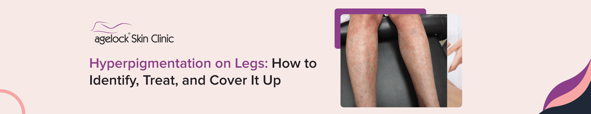 Hyperpigmentation On Legs
