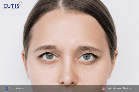 Drooping Eyebrows: The What, Why, and How