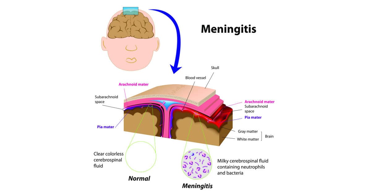 Prevent Meningitis in College Dorms Now