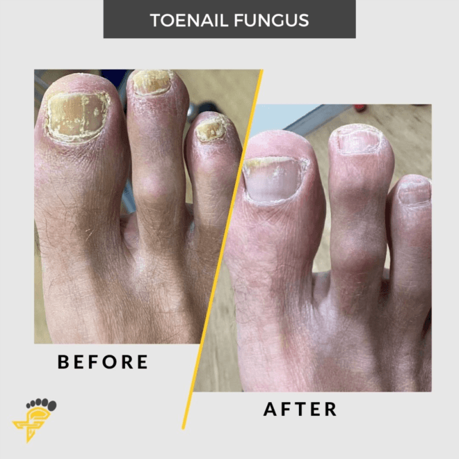 Is That Fungus in Your Toenails? Don't Be Embarrassed, Get Informed!