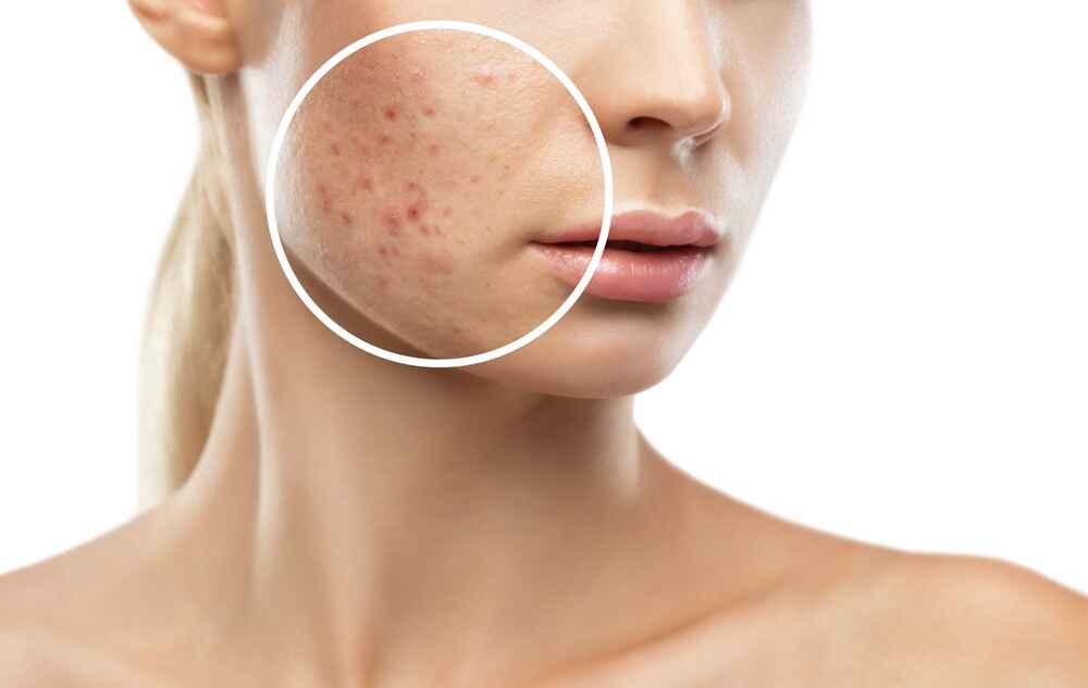 Affordable Laser Treatment for Scars Removal in Delhi