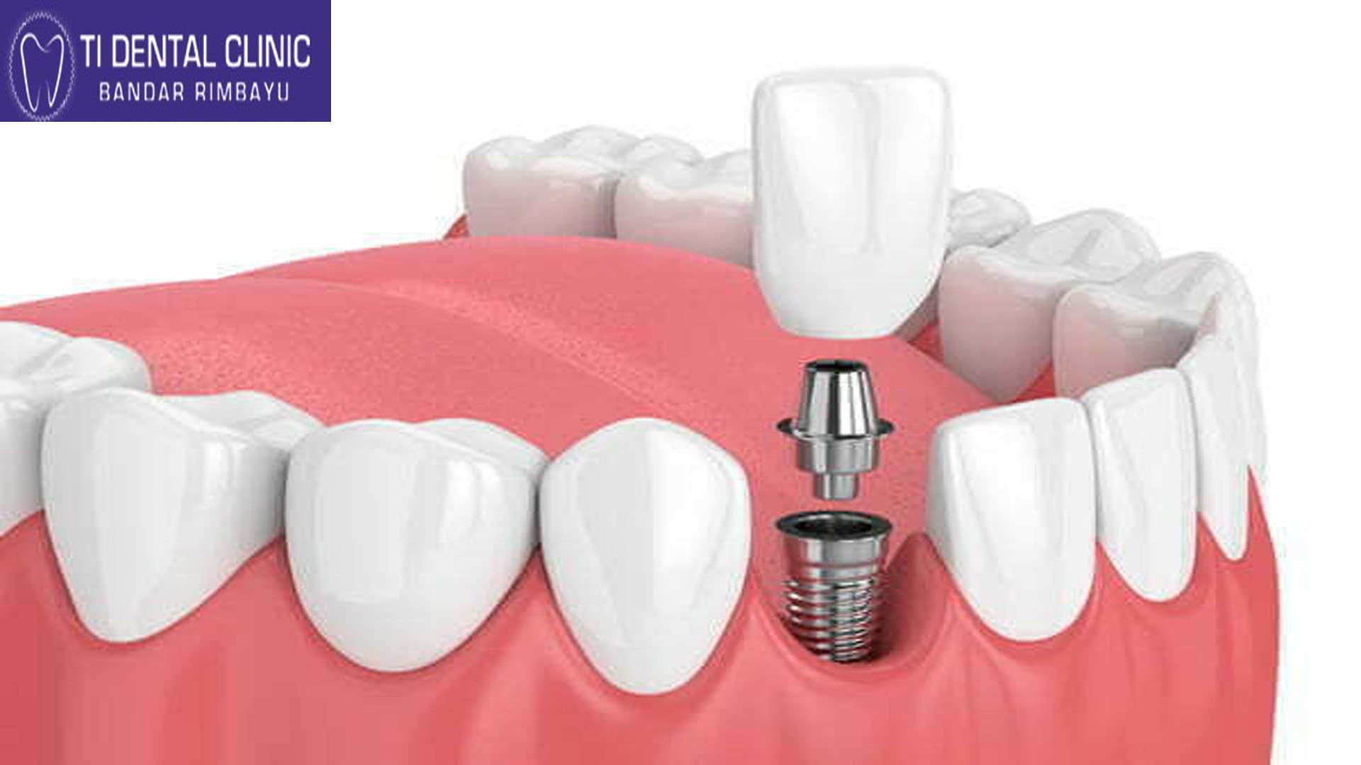 Dental Braces – Principles, Types, and Clinical Applications