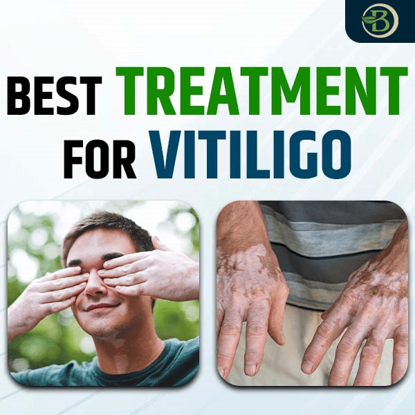 Vitiligo Disease Treatment: Natural Solutions for Skin Pigmentation Recovery