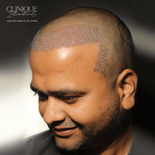 Best Hair Transplant in india