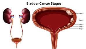 Comprehensive Guide to Bladder Cancer Symptoms
