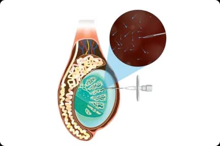 surgical sperm retrieval in Hyderabad