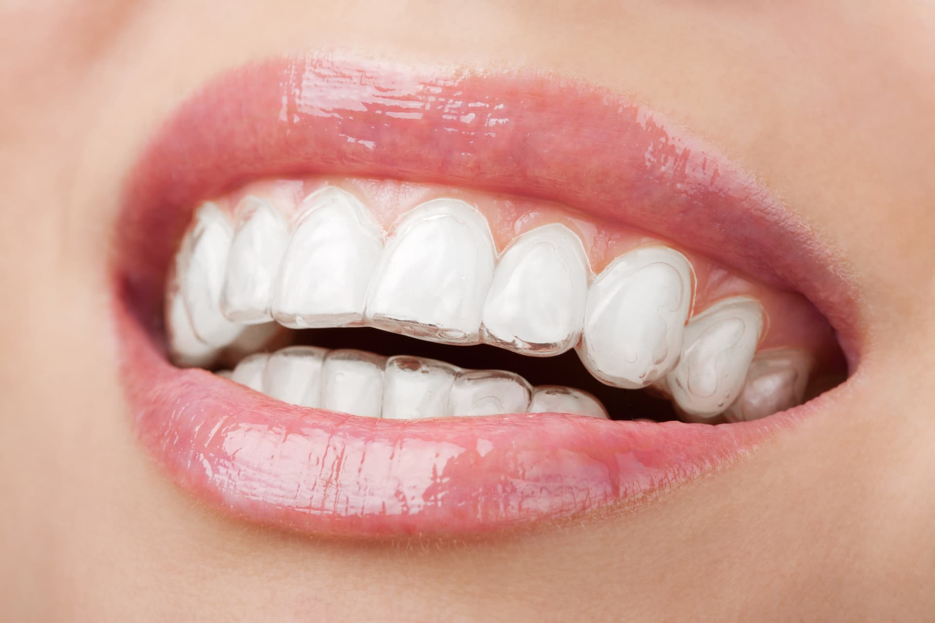 Dental Implants vs Dentures and Bridges