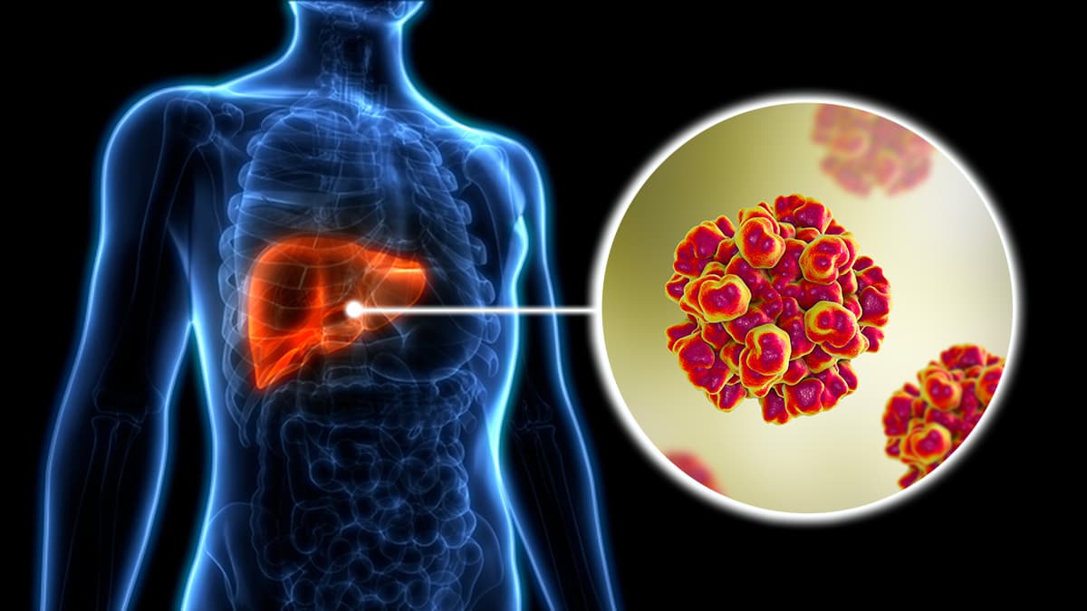 Hepatitis Explained: A Complete Guide to Liver Health