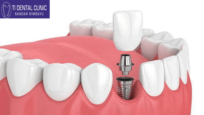 Introducing Invisible Braces 2.0: The Latest Solutions for Straighter Smiles
