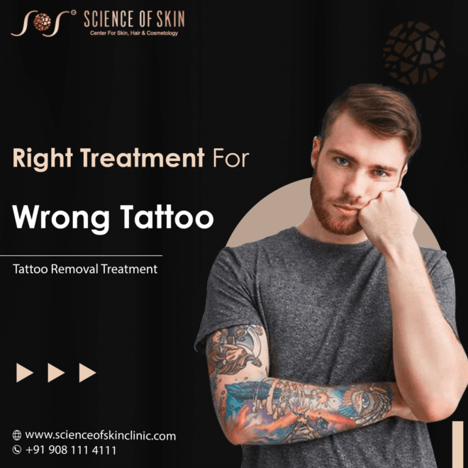 Unveiling the Science of Laser Tattoo Removal at Skin and Hair Clinic