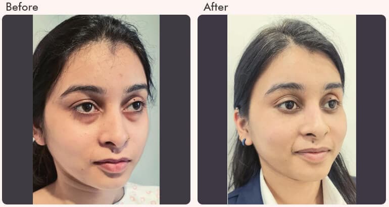 Eyelid surgery cost in Delhi - Dr RAjat Gupta
