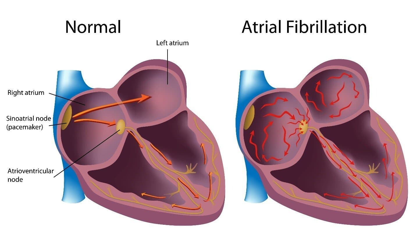 Natural AFib Treatment: Holistic Healing in LA & Burbank