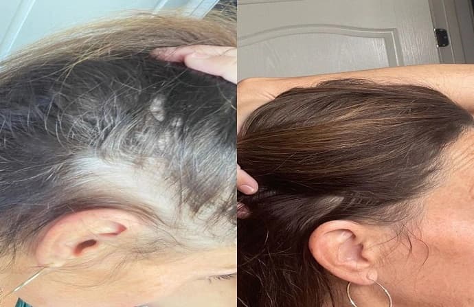From Bald to Bold | Hair Transplant Dubai Results