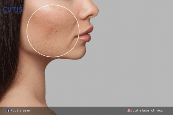 3 Cutis Treatments that Can Tighten Pores and Improve Skin Texture