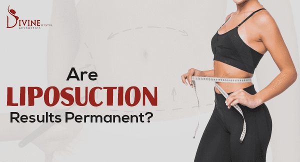 Is Liposuction A Permanent Solution?