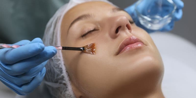 What Are the Benefits of Chemical Peels in Hobart?