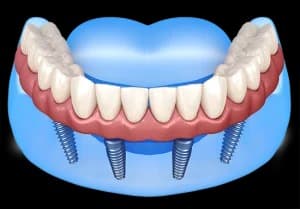 Full Mouth Dental Implants Albany