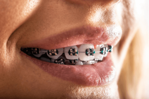 Affordable Braces in Dubai: Enhancing Smiles at National Medical Center, Satwa