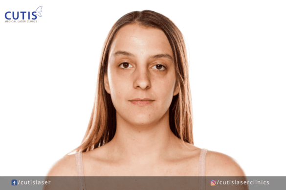 Can You Prevent Dark Undereye Circles?