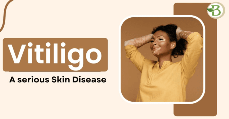 What exactly is Vitiligo Disease, and how can it be Treated? Vitiligo Disease Treatment