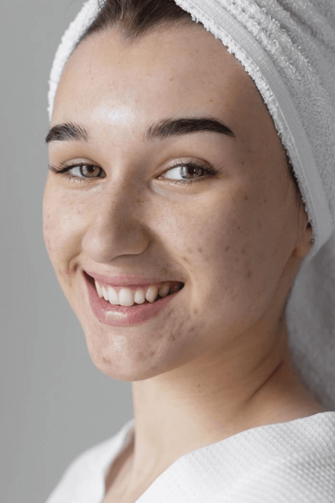 Advanced Pimple Treatments for Clear Skin